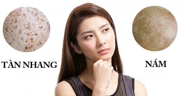 Phân Biệt Nám Tàn Nhang và Cách Điều Trị Tốt Nhất 1 5 1