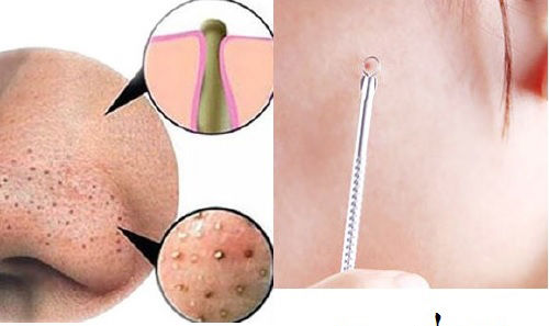 Mụn đầu đen không nặn có thành nốt ruồi 1 cach nam mun dau den dung cach 20180201105051