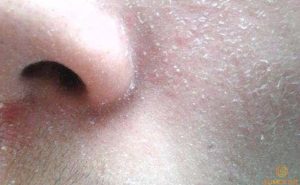 Da Bong tróc 2 bên cánh mũi