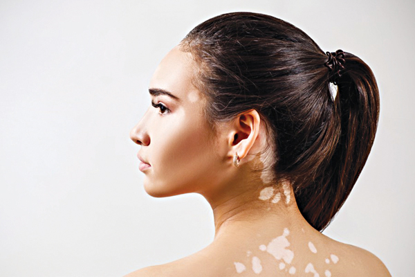 CHĂM SÓC DA VÀ CHỐNG NẮNG VỚI BỆNH BẠCH BIẾN 1 dieu tri bach bien