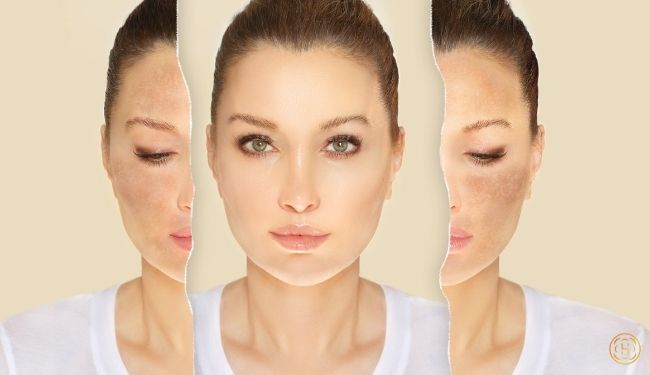 BẠN LO LẮNG NHỮNG MẢNG THÂM TRÊN MÔI VÀ TRÊN MẶT ? 1 n m da l g 2