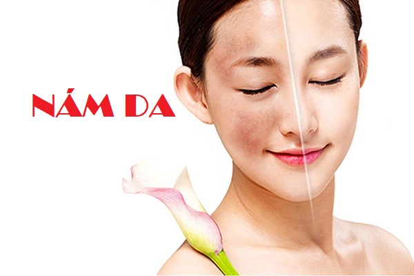 LÀM THẾ NÀO ĐỂ CHE VẾT NÁM DA ? | sumdfine.com 1