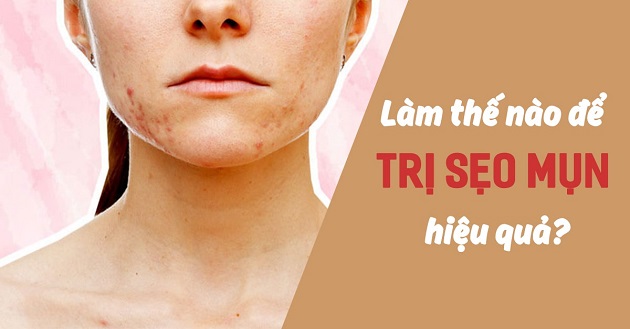 MẸO ĐỂ NGĂN NGỪA VÀ GIẢM SẸO MỤN HOẶC VẾT THÂM DO MỤN 1 ngan ngua seo minjpg