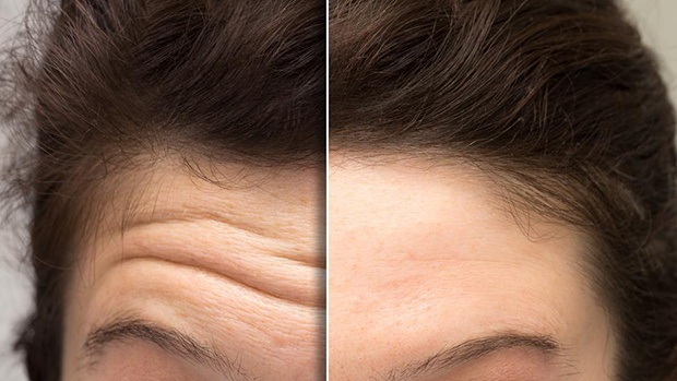 5 LÝ DO KHIẾN BẠN CÓ NẾP NHĂN TRÊN TRÁN 1 nhan tran