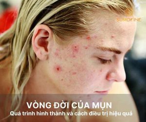 Vòng đời của mụn