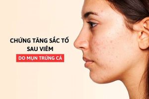 tăng sắc tố sau viêm