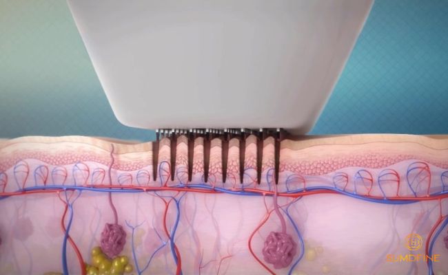 Công nghệ RF Microneedle