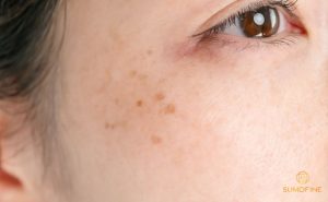 3 xu hướng mới trong điều trị nám & chống lão hóa da 2025 30 Xu hướng trị nám & chống lão hóa 2026