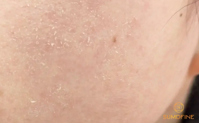 6 Tác hại của kem chống nắng khi dùng sai cách & Cách phòng tránh hiệu quả 3 Tác hại của việc dùng kem chống nắng sai cách: Khô da