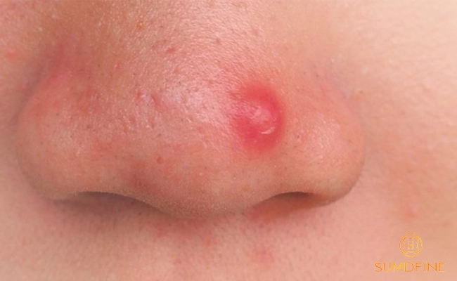 6 Tác hại của kem chống nắng khi dùng sai cách & Cách phòng tránh hiệu quả 2 Tác hại của việc dùng kem chống nắng sai cách: Nổi mụn