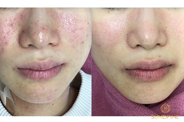 Chăm sóc da sau peel sau 0-6 tiếng