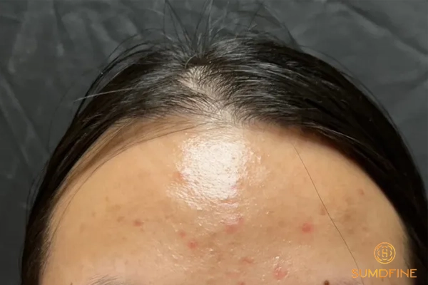 Da đang điều trị nên dùng kem chống nắng spf 70