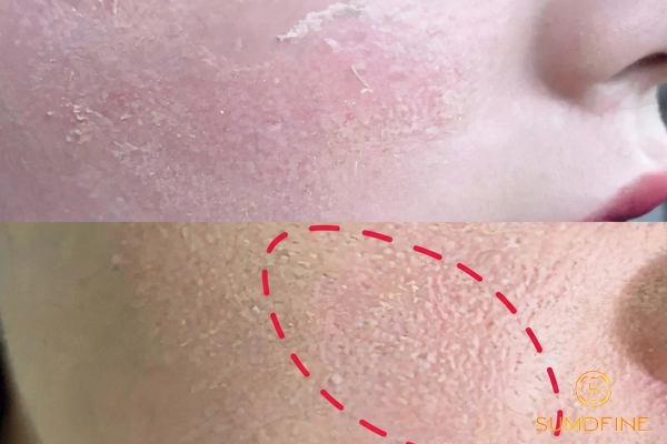 Để kem chống nắng lâu trên da có sao không? 6 Tác hại cần biết 3 Tác hại khi để kem chống nắng lâu trên da