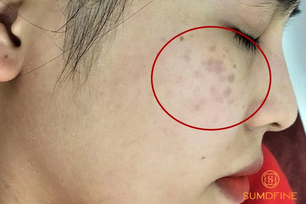 Biểu hiện của nám chân đinh