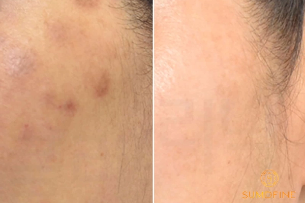 Nám da có tự hết không? Bao lâu thì hết? 6 Các phương pháp trị nám hiệu quả