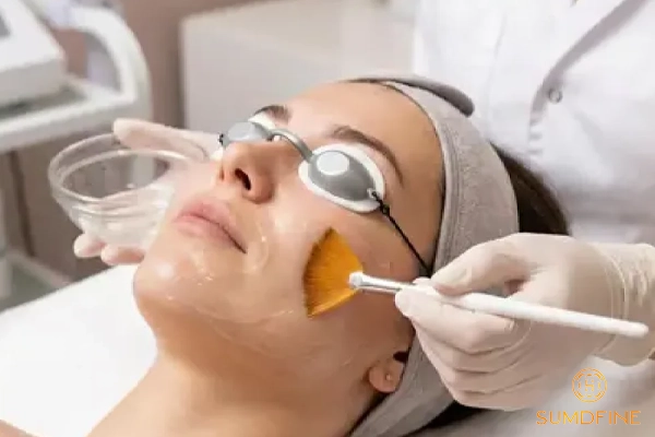 Trị nám mảng bằng laser hoặc peel da hoá học