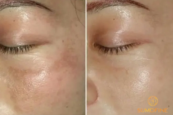 Hướng dẫn phân biệt nám chân đinh và nám mảng chính xác 6 Điều trị nám chân đinh và nám mảng