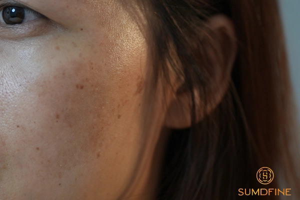 Hướng dẫn phân biệt nám chân đinh và nám mảng chính xác 5 Đối tượng dễ bị nám mảng và nám chân đinh nhất