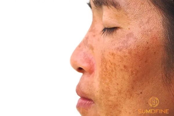 Nám da có tự hết không? Bao lâu thì hết? 3 Hậu quả khi nám da bắt đầu tiến triển