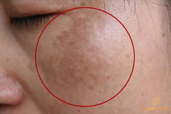 Nám da là gì? Nguyên nhân, phân loại & cách trị hiệu quả 2 Hình ảnh nám da mặt