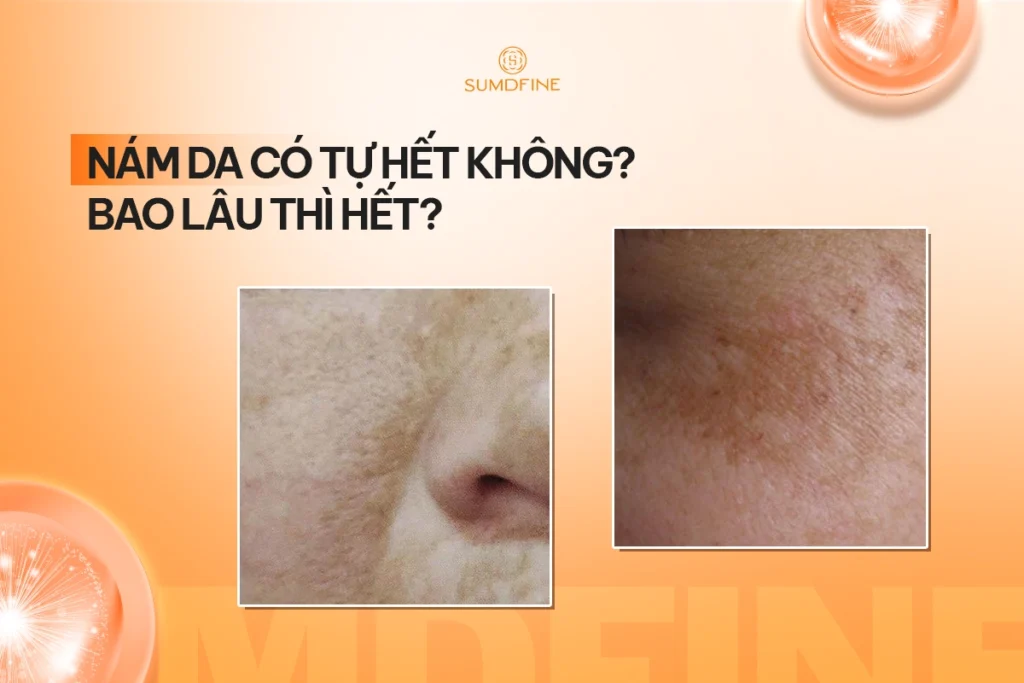 Nám da có tự hết không? Bao lâu thì hết? 1 Nám da có tự hết không?