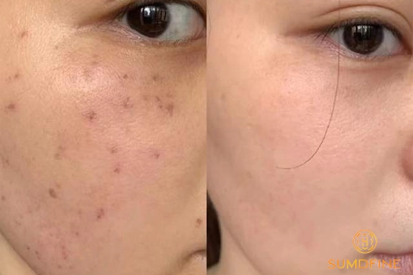 Nám da có tự hết không? Bao lâu thì hết? 2 Nám da có tự hết không?