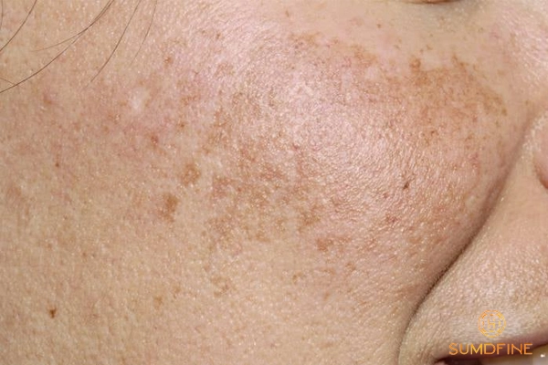 Định nghĩa nám da