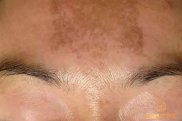 Uống thuốc tránh thai hằng ngày có bị nám không? 3 Nám da do sử dụng thuốc tránh thai