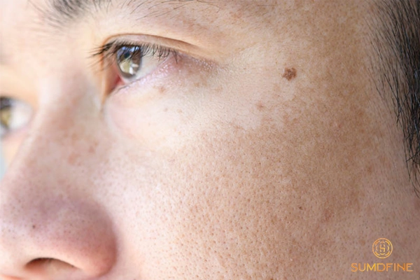 Nám da ở nam giới