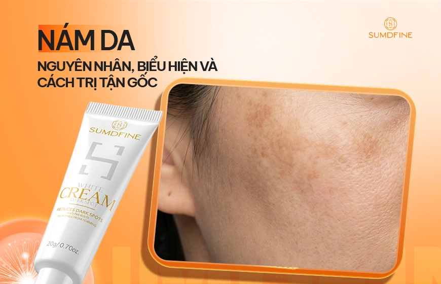 Nám da là gì? Nguyên nhân, phân loại & cách trị hiệu quả 1 Nám da là gì?