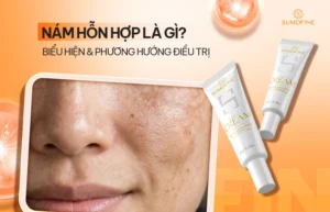 Nám hỗn hợp là gì?