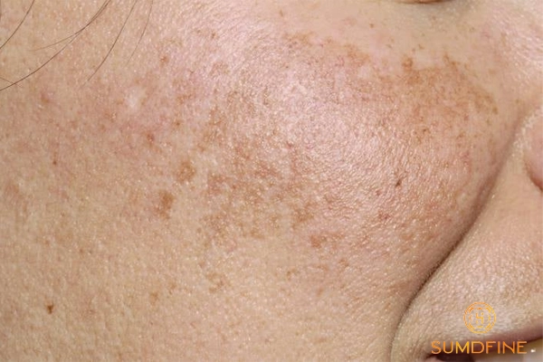 Hình ảnh của nám da hỗn hợp