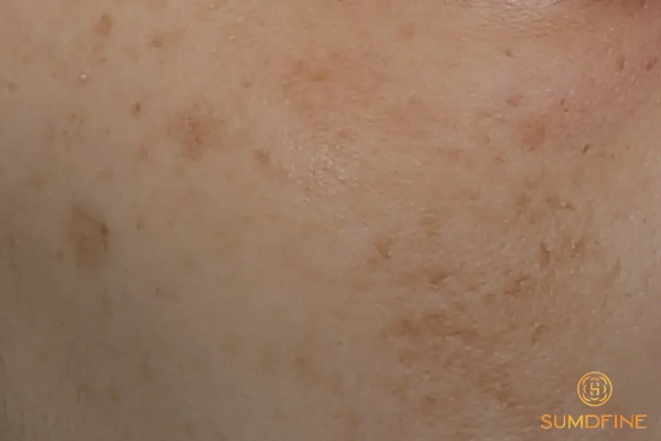 Biểu hiện của nám mảng