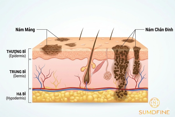 Hướng dẫn phân biệt nám chân đinh và nám mảng chính xác 3 Nám chân đinh nằm ở lớp da nào so với nám mảng