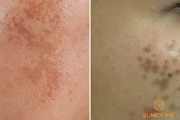 Hướng dẫn phân biệt nám chân đinh và nám mảng chính xác 2 Nhận biết nám chân đinh và nám mảng