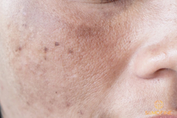 Những nguyên nhân gây nám tàn nhang