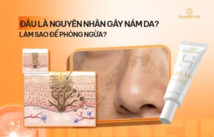 Những nguyên nhân gây nám da