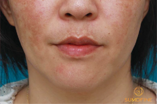 Nám da có tự hết không? Bao lâu thì hết? 4 Nguyên nhân khiến nám da trầm trọng