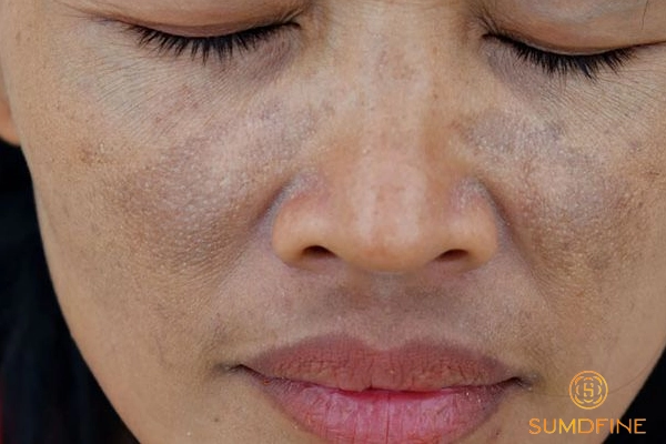 Hướng dẫn phân biệt nám chân đinh và nám mảng chính xác 4 Nguyên nhân gây nám chân đinh và nám mảng