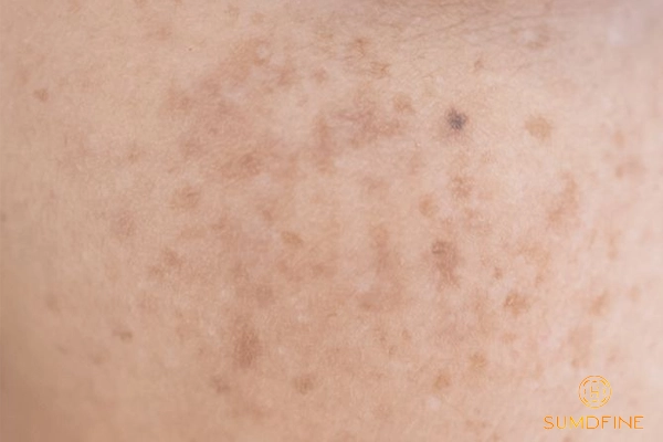 Tự nhân diện nám, tàn nhang tại nhà