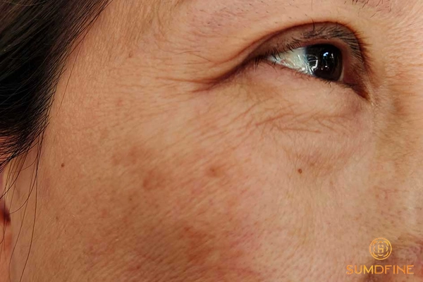 Nguyên nhân gây nám thượng bì