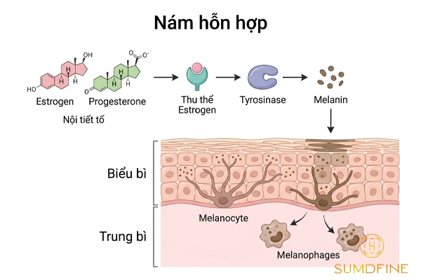 Rối loạn nội tiết là nguyên nhân gây nám hỗn hợp