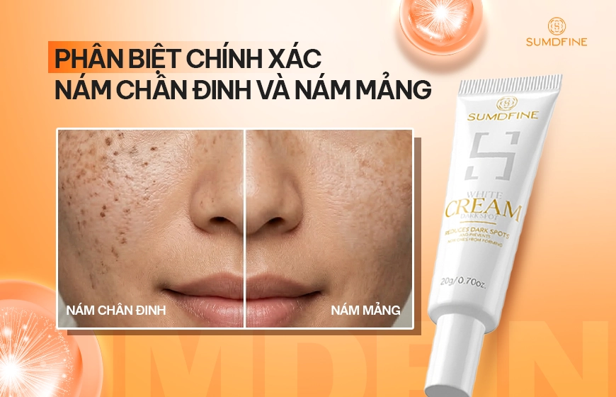 Hướng dẫn phân biệt nám chân đinh và nám mảng chính xác 1 Phân biệt nám chân đinh và nám mảng