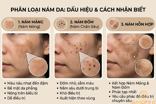 Phân biệt 3 loại nám da