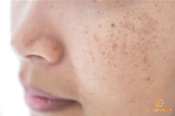 Nám da là gì? Nguyên nhân, phân loại & cách trị hiệu quả 3 Phân loại nám da - nám chân sâu