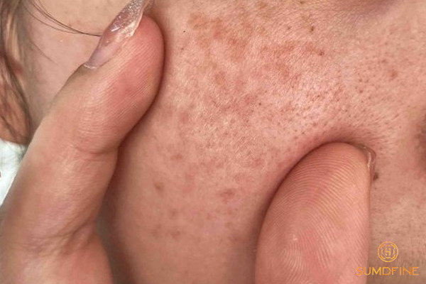 Nám da là gì? Nguyên nhân, phân loại & cách trị hiệu quả 10 Hướng dẫn cách phòng ngừa nám da