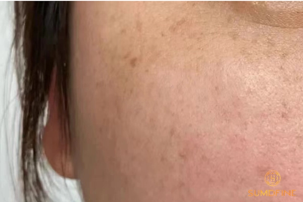 Tia UV là nguyên nhân hàng đầu gây nám mảng