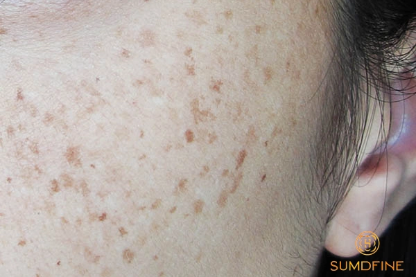 Điều trị nám chân đinh