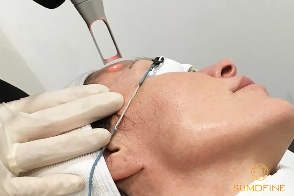 Nám da có tự hết không? Bao lâu thì hết? 5 Trị nám da bằng laser bao lâu thì hết
