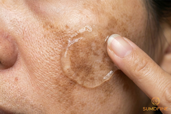 Nám da là gì? Nguyên nhân, phân loại & cách trị hiệu quả 5 Trị nám da bằng phương pháp tự nhiên tại nhà